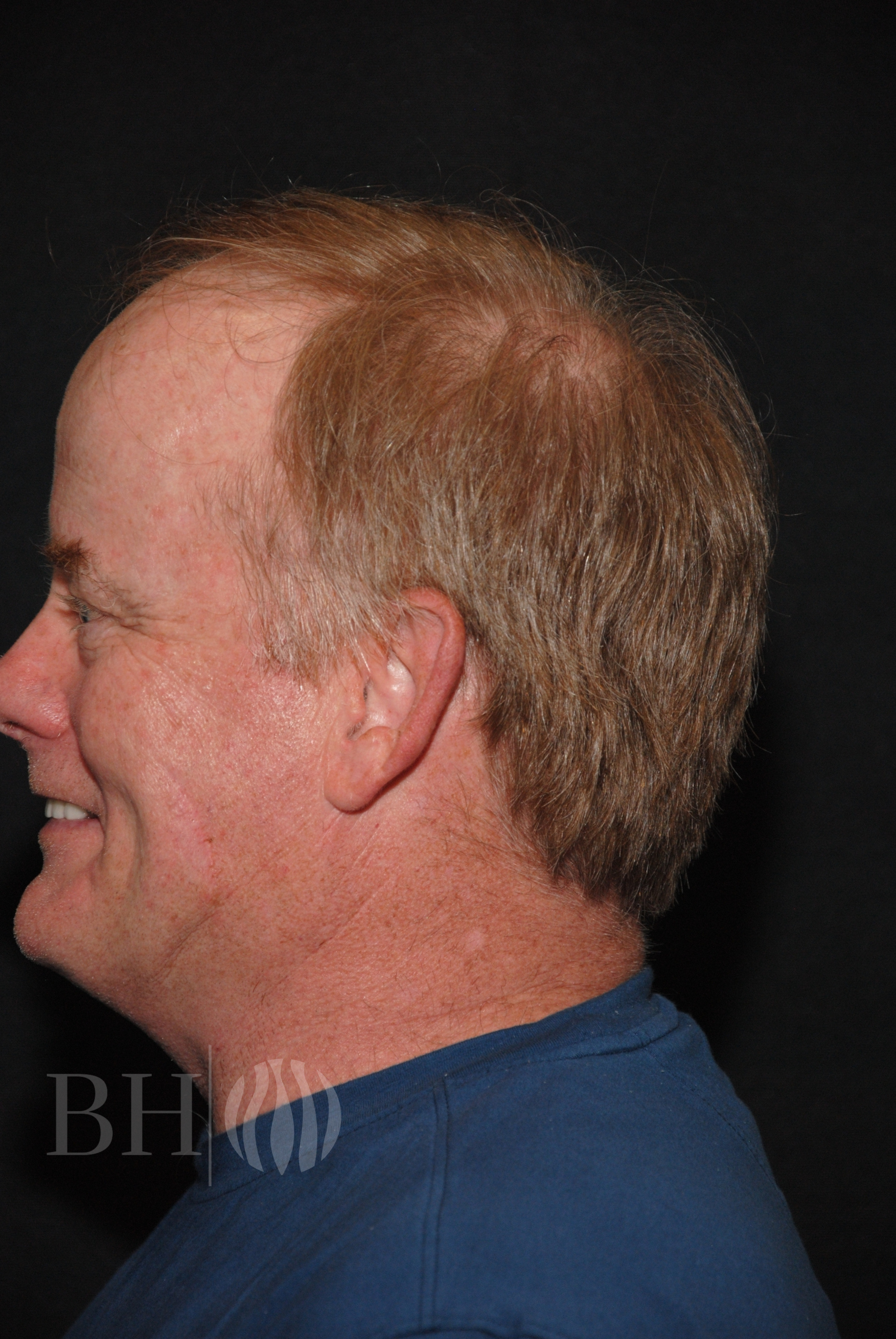 Neograft Hair Restoration Before & After